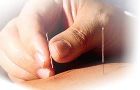 Acupuncture St. Louis