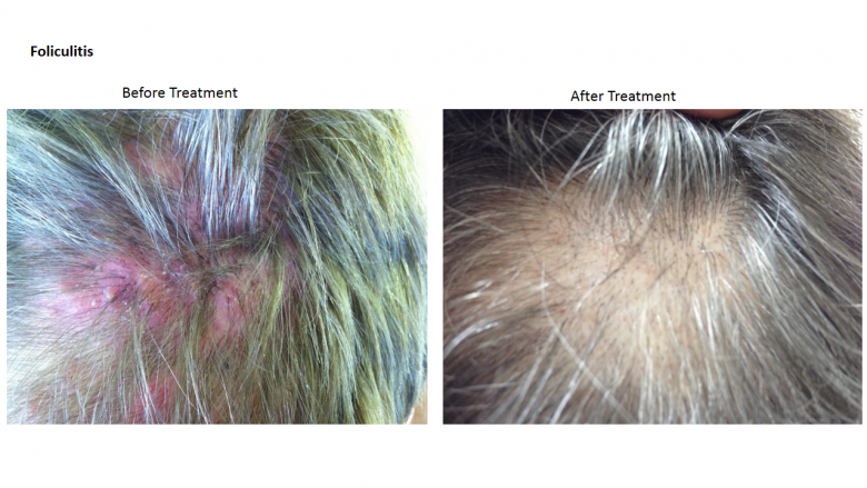 Foliculitis treated at St. Louis Acupuncture and Chinese Herbal Medicine